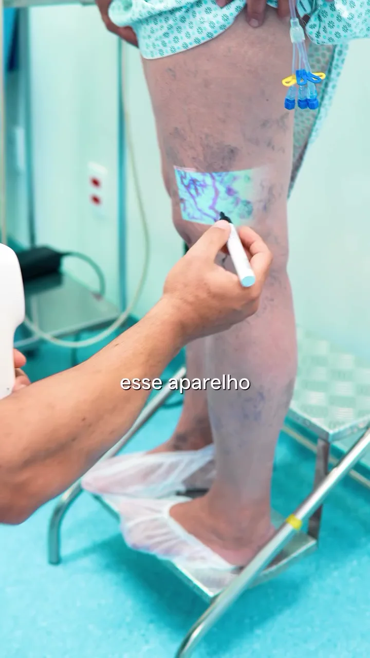 Realidade aumentada projetando o mapa das veias na perna